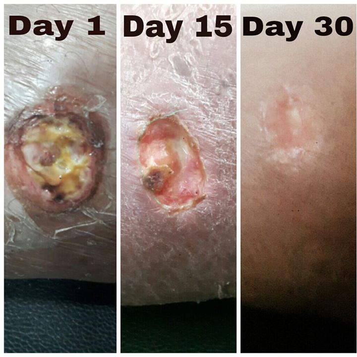 She was suffering from this DIABETIC VENOUS ULCER SINCE LONG, AGE 50+ # SHE HAD GIVEN UP # CONGRATULATIONS TO DR. PRIYANKA & TEAM @ MISSION HEALTH DHARNIDHAR BRANCH TO BRING SUPER DUPER HIT RESULTS # Mission Health ulcer clinic has many modalities to cure worst of the ulcers.