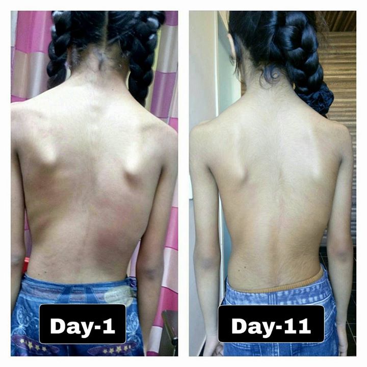 See it to believe it # MissionHealth Ahmedabad super speciality spine clinic # Improvements in 10 year girl's Scoliotic curves # Micro Analysis and correction by Spine specialists of Mission Health Spine clinic # Quality Delivery pays results # Watch on progression of curve regularly is very important # Life is important for this growing girl # Great results # Still Mission Health team working on her.